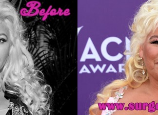 Beth Chapman Plastic Surgery