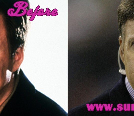 Bob Costas Plastic Surgery