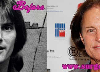 Bruce Jenner Facelift