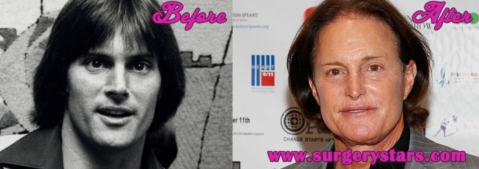 Bruce Jenner Facelift