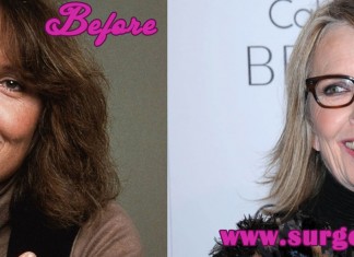 Diane Keaton Plastic Surgery