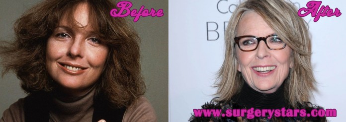 Diane Keaton Plastic Surgery