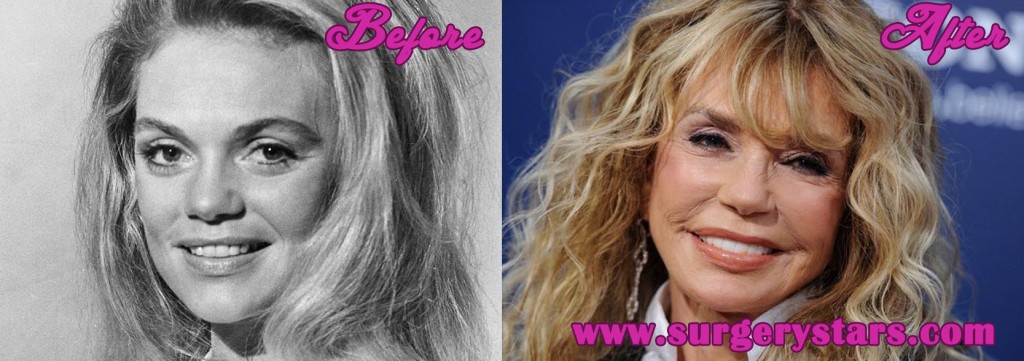 Dyan Cannon Plastic Surgery