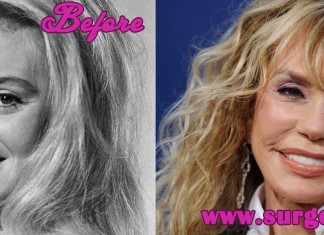 Dyan Cannon Plastic Surgery