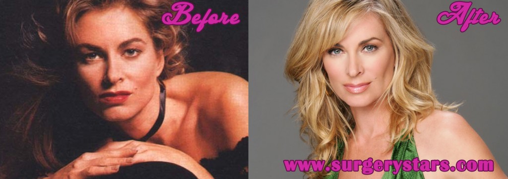 Eileen Davidson Plastic Surgery