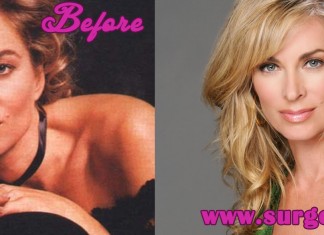 Eileen Davidson Plastic Surgery