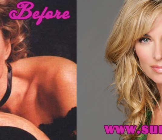 Eileen Davidson Plastic Surgery