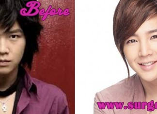 Jang Geun Suk Plastic Surgery
