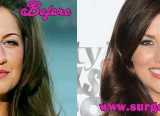 Jillian Harris Nose Job
