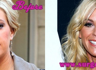 Kate Gosselin Plastic Surgery