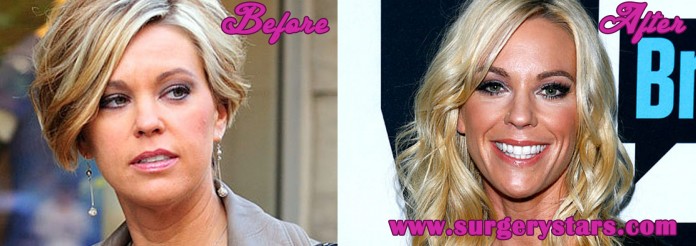 Kate Gosselin Plastic Surgery