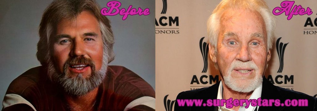 Kenny Rogers Facelift