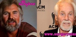 Kenny Rogers Facelift