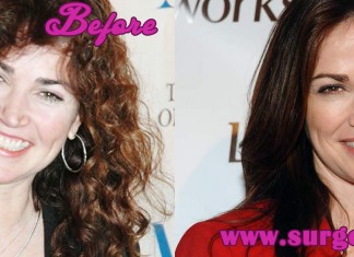 Kim Delany Plastic Surgery