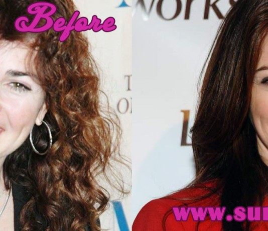 Kim Delany Plastic Surgery