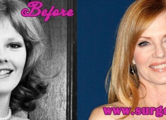 Marg Helgenberger Plastic Surgery