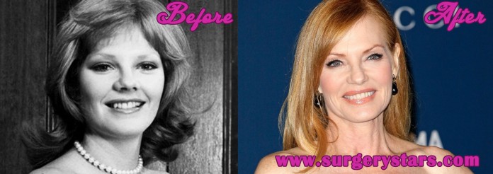 Marg Helgenberger Plastic Surgery