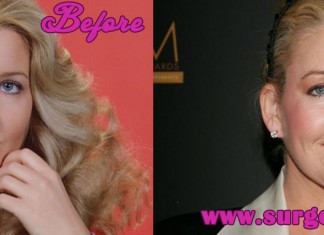 Melody Thomas Scott Plastic Surgery