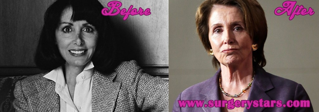 Nancy Pelosi Plastic Surgery