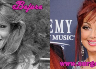 Naomi Judd Plastic Surgery