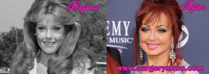 Naomi Judd Plastic Surgery