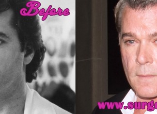 Ray Liotta Plastic Surgery