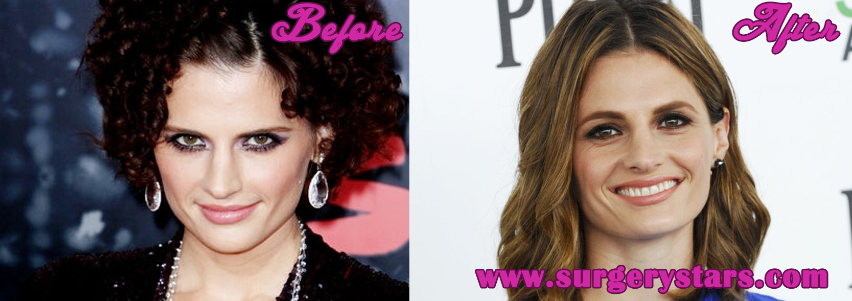 Stana Katic Plastic Surgery - Before and After Pictures.