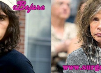 Steven Tyler Plastic Surgery