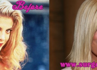 Tori Spelling Plastic Surgery