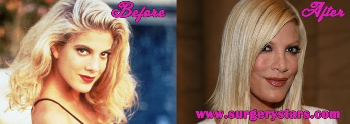 Tori Spelling Plastic Surgery