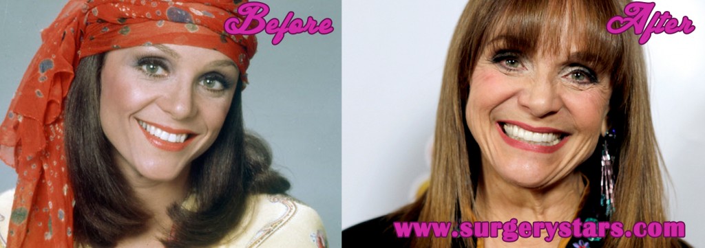 Valerie Harper Plastic Surgery