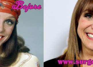 Valerie Harper Plastic Surgery