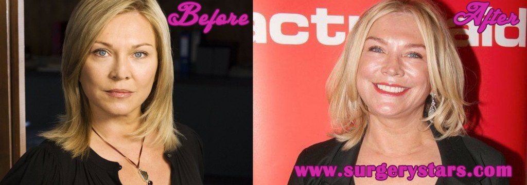 Amanda Redman Plastic Surgery