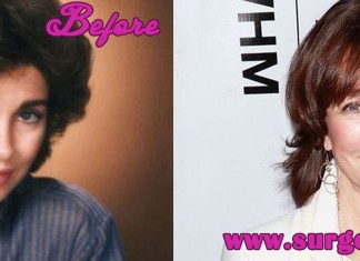 Anne Archer Plastic Surgery