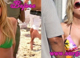 Ashley Benson Boob Job
