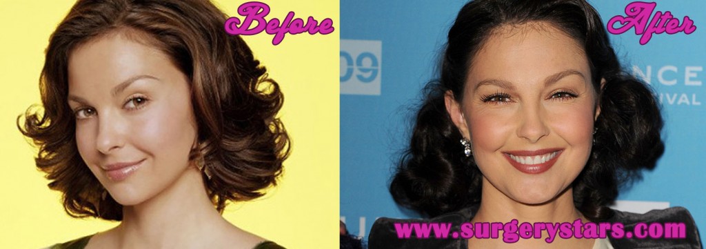 Ashley Judd Plastic Surgery