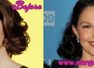 Ashley Judd Plastic Surgery