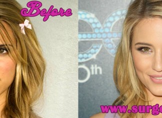 Rhinoplasty Before and After Pictures