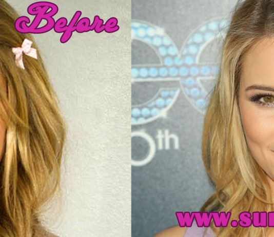Rhinoplasty Before and After Pictures