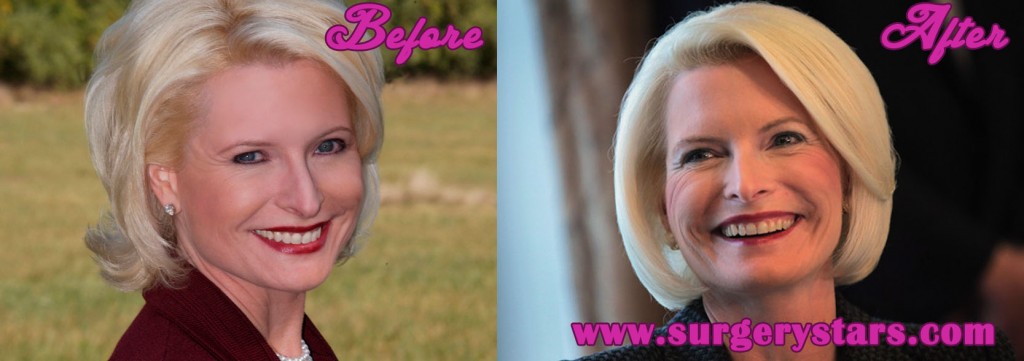 Callista Gingrich Plastic Surgery