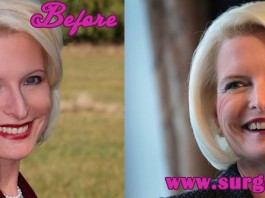 Callista Gingrich Plastic Surgery