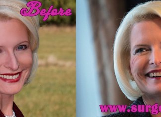 Callista Gingrich Plastic Surgery
