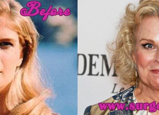 Candice Bergen Plastic Surgery