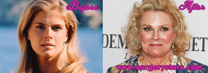 Candice Bergen Plastic Surgery