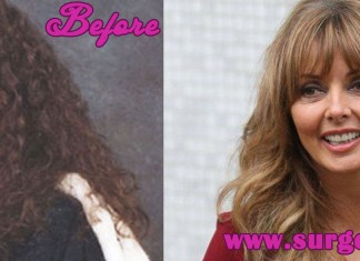 Carol Vorderman Plastic Surgery