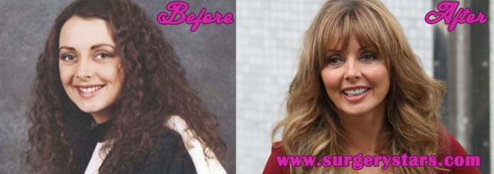 Carol Vorderman Plastic Surgery