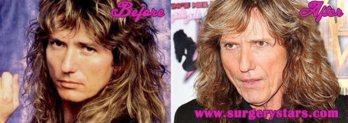 David Coverdale Plastic Surgery