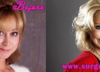 Felicity Kendal Plastic Surgery