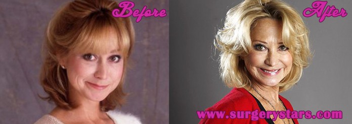 Felicity Kendal Plastic Surgery