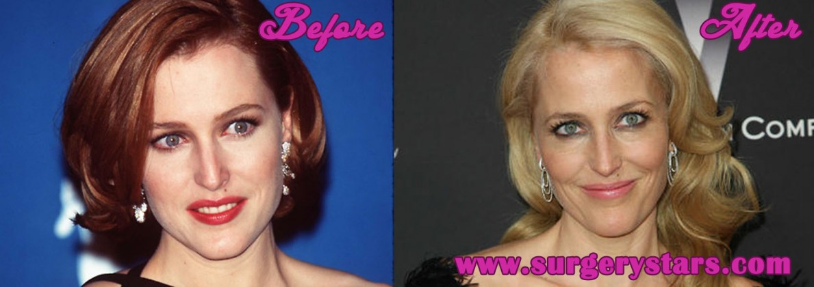 Gillian Anderson Plastic Surgery Pictures